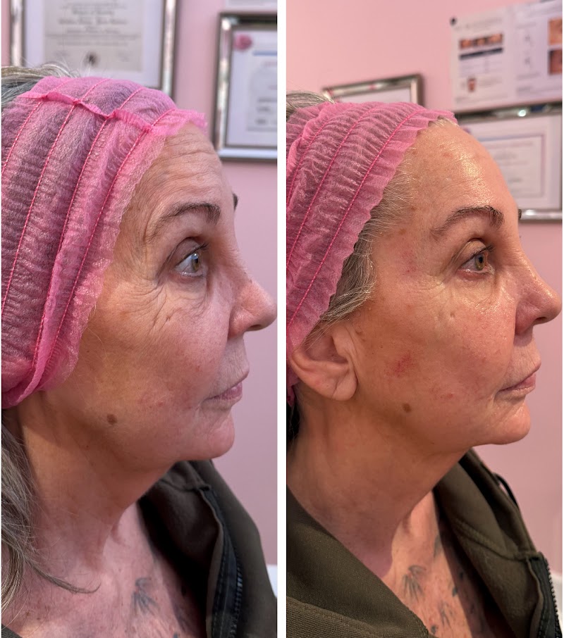 Botox La Belle Peau